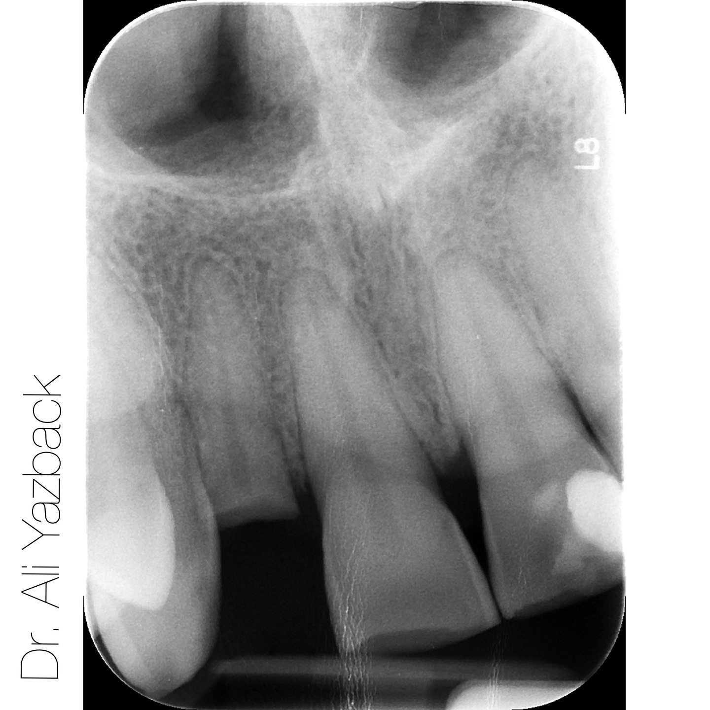 Did you know that Dental Implant are a lifetime solution that can last a lifetime with proper care. They are the only tooth replacement o...