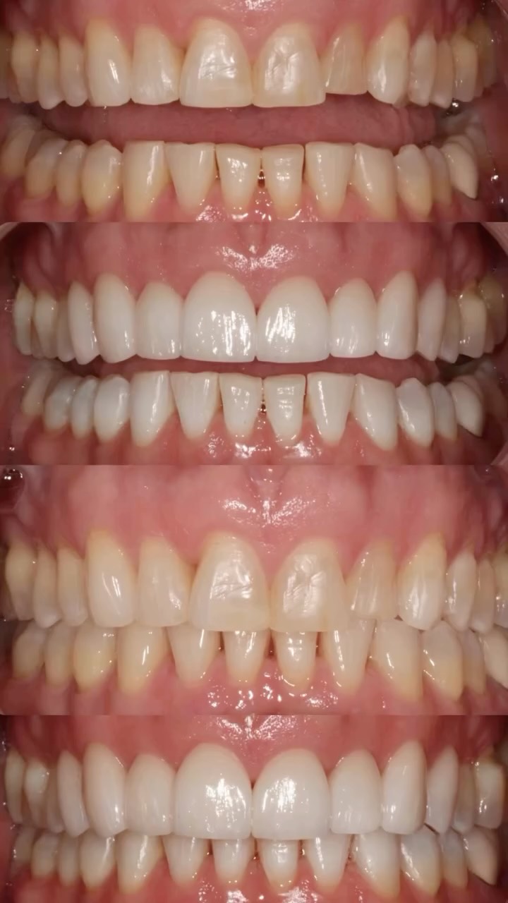 Gift yourself a new smile! . . . Call (305) 670-5100 to schedule your SMILE MAKEOVER! #miami #miamidentistry #smile #veneers smiledesign