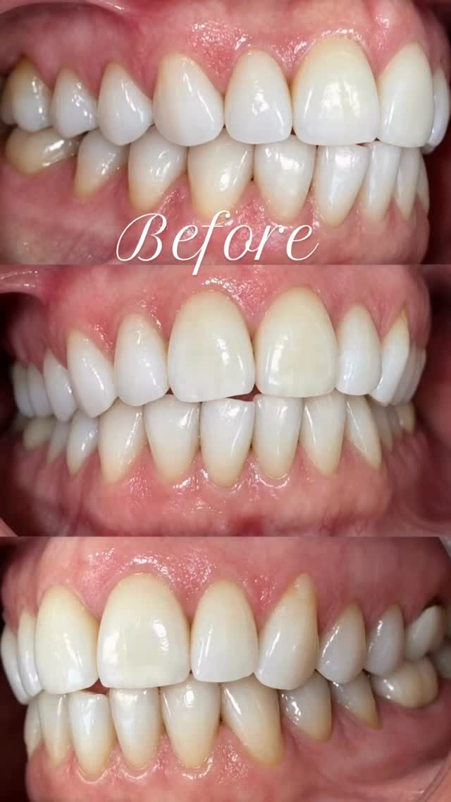 Still thinking about Invisalign? Your dream smile may be closer than you think! It&rsquo;s never too late to start your journey toward a straig...